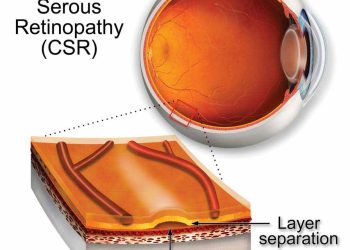 CENTRAL SEROUS CHORIORETINOPATHY (CSCR)