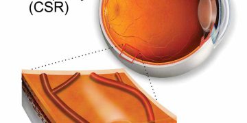 CENTRAL SEROUS CHORIORETINOPATHY (CSCR)