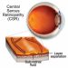 CENTRAL SEROUS CHORIORETINOPATHY (CSCR)