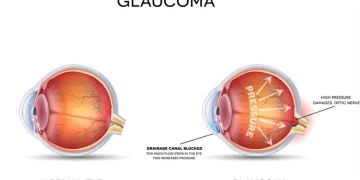 Glaucoma triad under controversy