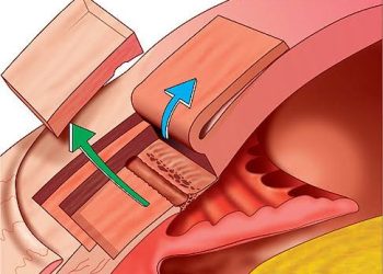 Non-penetrating glaucoma surgery (NPGS)