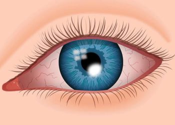 Corneal signs aids to diagnosis capsule