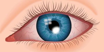 Corneal signs aids to diagnosis capsule