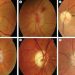 Optic Neuropathy