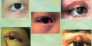 Eyelid swellings