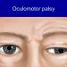 When to send a patient for MRI in a case of 3rd nerve palsy and why ?
