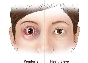 DD of proptosis and dystopia