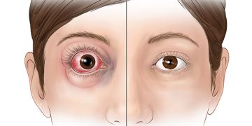 DD of proptosis and dystopia