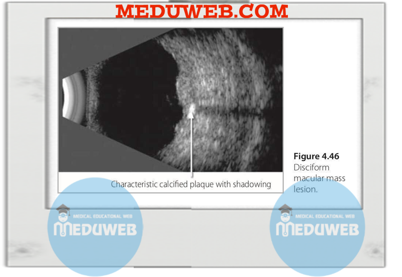 Normal and abnormal B-scan 7 Untitled1 7