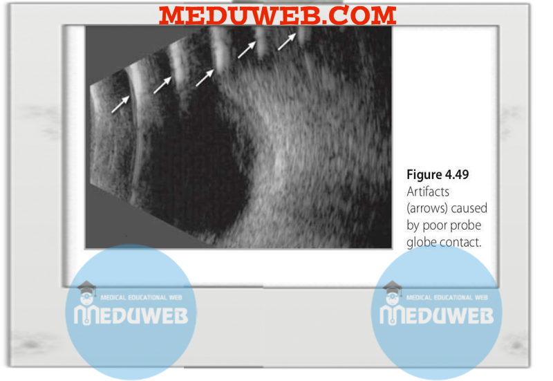 Normal and abnormal B-scan 3 ikj
