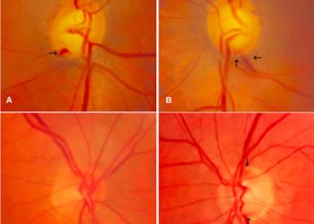 Disc hemorrhages in glaucoma