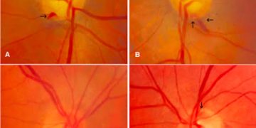Disc hemorrhages in glaucoma