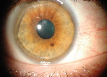 Stepwise approach for peripheral corneal thinning ( PUK)