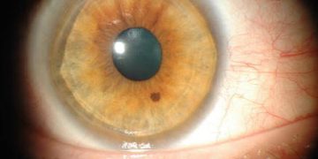 Stepwise approach for peripheral corneal thinning ( PUK)