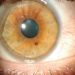 Stepwise approach for peripheral corneal thinning ( PUK)