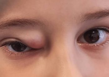 Facts of Rhabdomyosarcoma