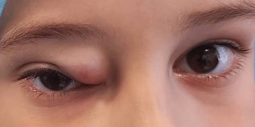 Facts of Rhabdomyosarcoma