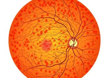Central retinal vein occlusion ( CRVO)