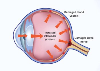 Stepwise approach for treatment of APAC