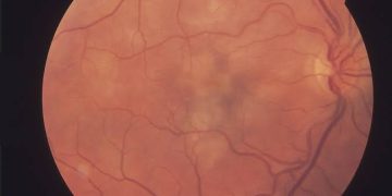 Clinical notes on white dot syndromes