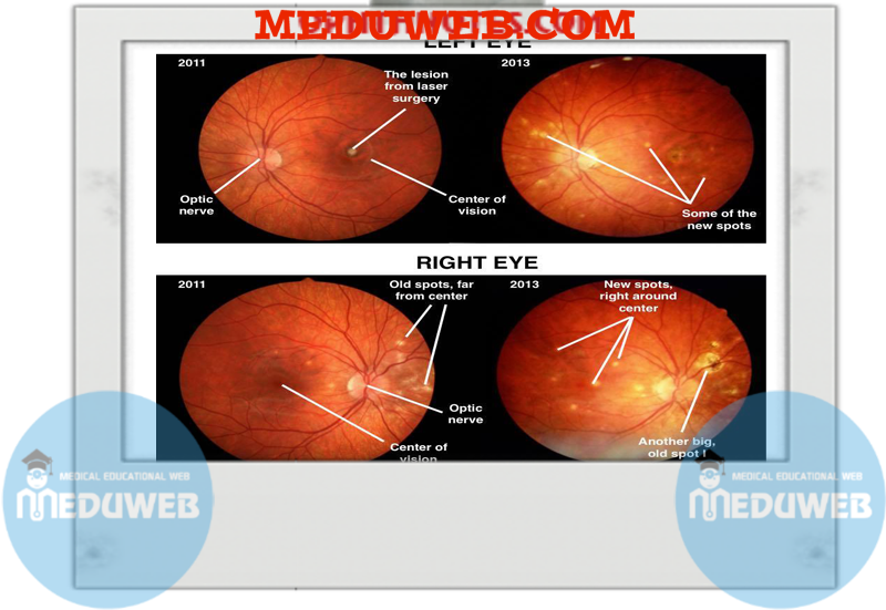 Clinical notes on white dot syndromes