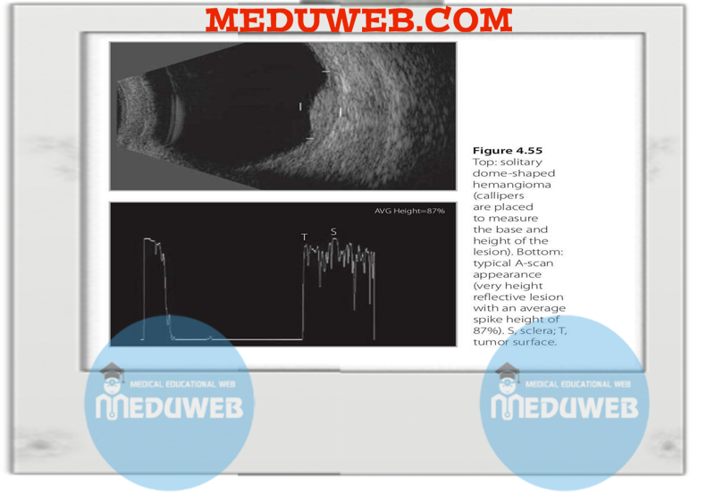 Normal and abnormal B-scan 5 t7t