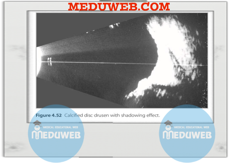 Normal and abnormal B-scan 6 ug