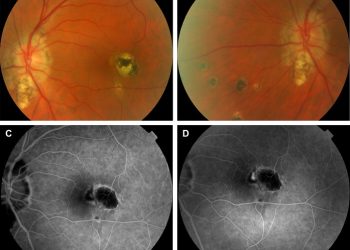 Presumed ocular histoplasmosis syndrome (POHS)