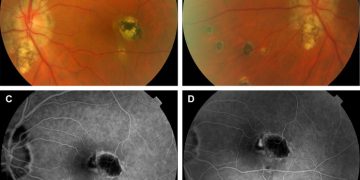 Presumed ocular histoplasmosis syndrome (POHS)