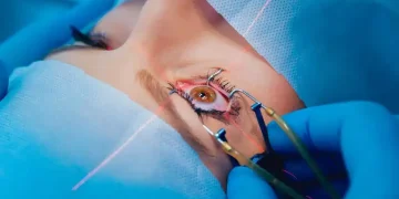 Decision Making alarming for Treatment Plan for Lasik