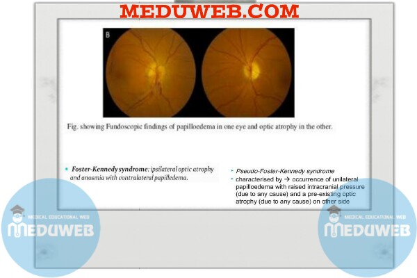 True and Pseudo Foster Kennedy Syndromes