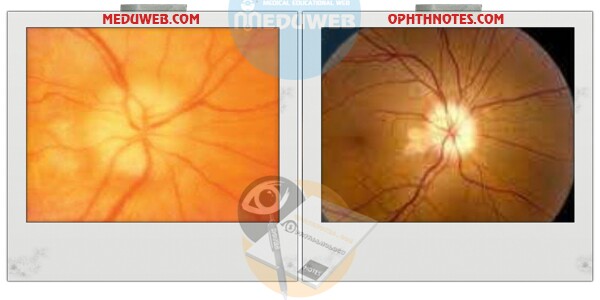 Clinical hints for diagnosis and treatment of AAION