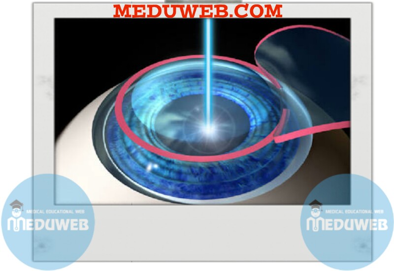 Decision Making alarming for Treatment Plan for Lasik