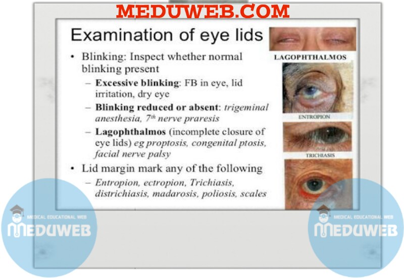Examining the eye lids hints