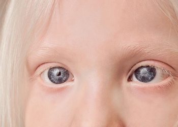 Ocular albinism short facts