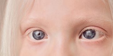 Ocular albinism short facts