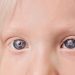 Ocular albinism short facts