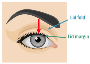 Examining the eye lids hints