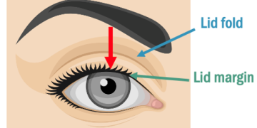 Examining the eye lids hints