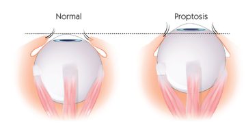 Laboratory diagnosis of Thyroid Eye Disease TED