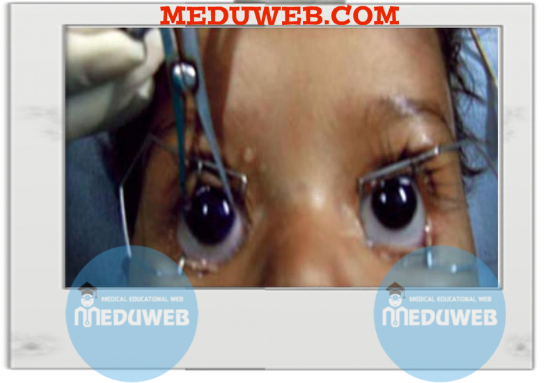 Childhood glaucoma 79 Untitled1 9