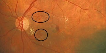 Retinal telangiectasias