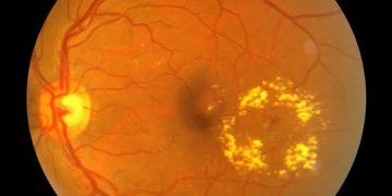 Cystoid macular oedema