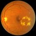 Cystoid macular oedema