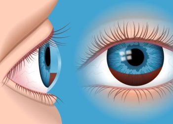 Uveitis-Glaucoma-Hyphema Syndrome