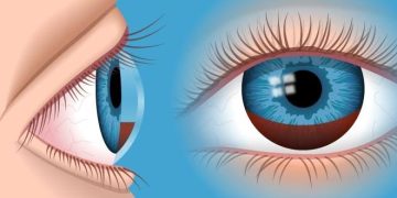 Uveitis-Glaucoma-Hyphema Syndrome