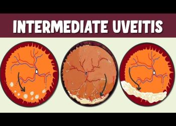 Intermediate uveitis