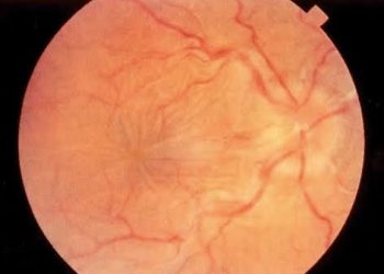 Hypotony Maculopathy