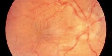 Hypotony Maculopathy