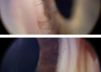 Axenfeld-Rieger syndrome(ARS)